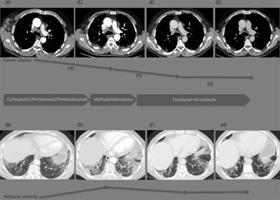 Successful treatment with docetaxel plus nintedanib in a patient with lung adenocarcinoma and pulmonary fibrosis: A case report and literature review